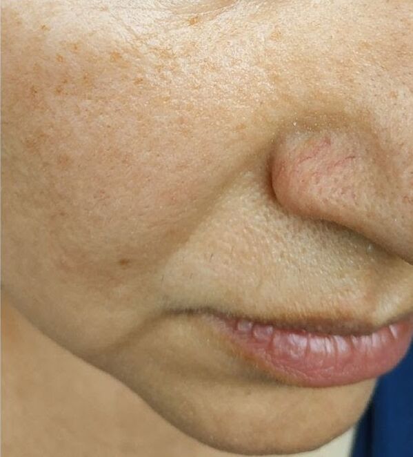 Around the age of 40, nasolabial folds appear