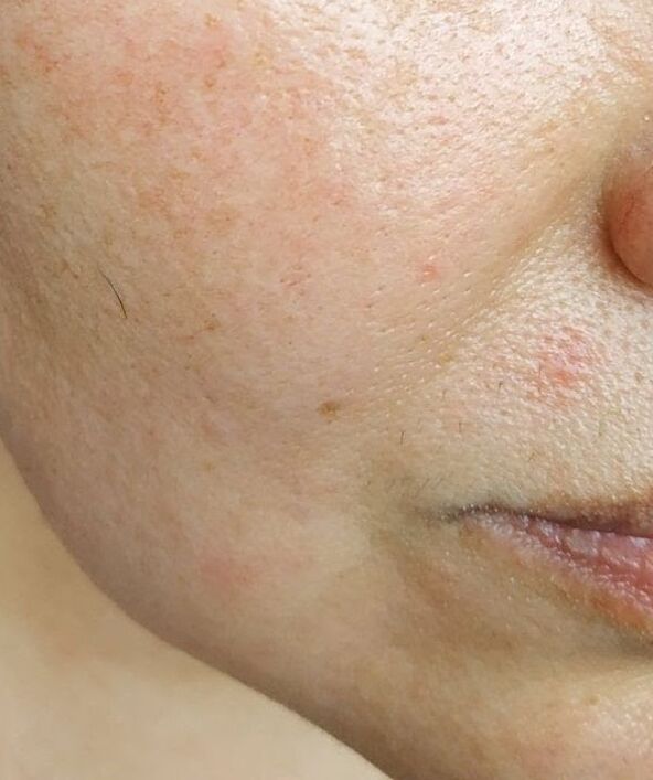 Intense has got rid of deep nasolabial folds